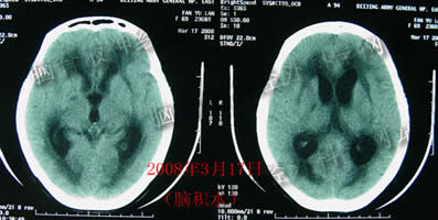 李小勇神经外科脑脊液专业