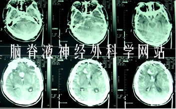 脑积水|李小勇|分流感染|分流管梗阻