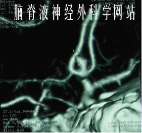 脑积水|李小勇|分流感染|分流管梗阻