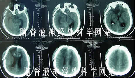 脑积水|李小勇|分流感染|分流管梗阻
