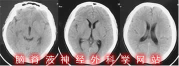 脑积水|分流感染|李小勇