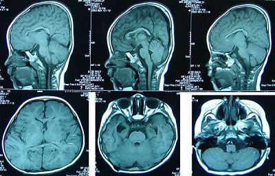 脑积水的治疗 脑脊液神经外科