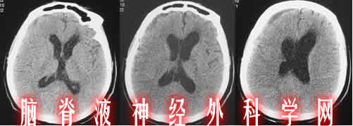 分流干梗阻|颅内感染