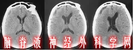 分流管堵塞|颅内感染