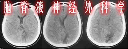 分流管阻塞|颅内感染