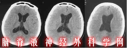 脑积水|分流并发症