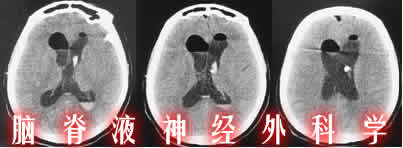 脑积水|分流并发症