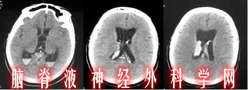 李小勇|脑积水|颅内感染|治疗