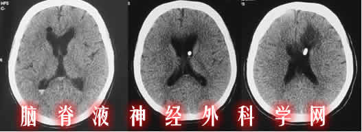 李小勇|脑积水治疗