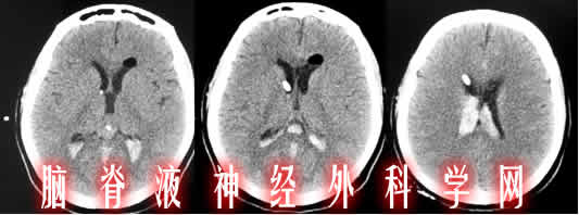 李小勇|脑积水|颅内感染|治疗