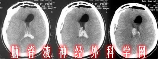 李小勇|脑积水|颅内感染|治疗