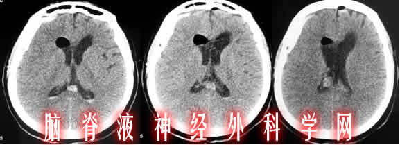 脑室分流感染|分流管梗阻