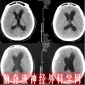 分流管堵塞