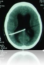 hydrocephalus