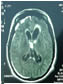 hydrocephalus