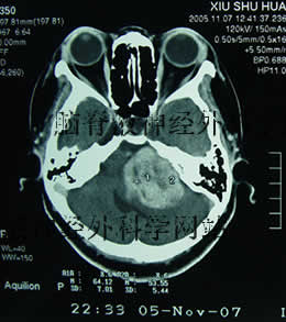 脑脊液神经外科学网站