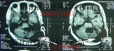 脑脊液神经外科学网站