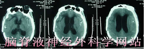 脑脊液神经外科学网站
