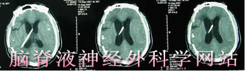 脑脊液神经外科学网站