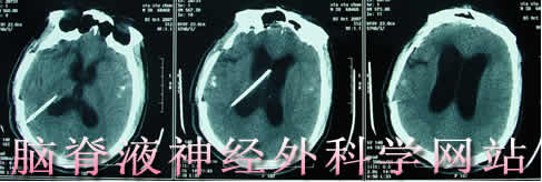 脑脊液神经外科学网站