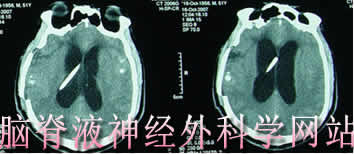 脑脊液神经外科学网站