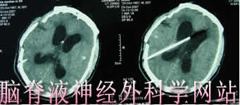 脑脊液神经外科学网站