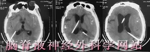 脑脊液神经外科学网站