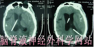 脑脊液神经外科学网站