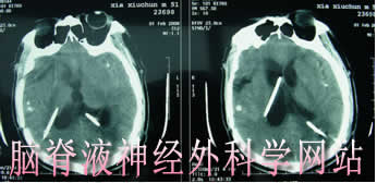 脑脊液神经外科学网站