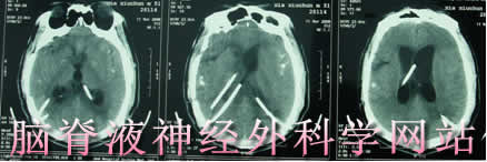 脑脊液神经外科学网站