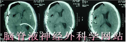 脑脊液神经外科学网站