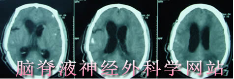 脑脊液神经外科学网站