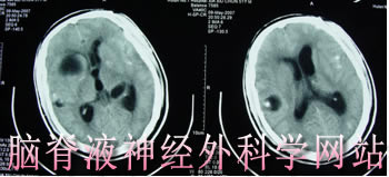 脑脊液神经外科学网站