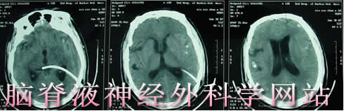 李小勇神经外科脑脊液专业网站