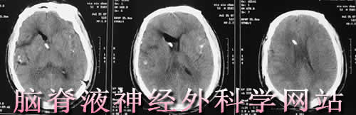 脑脊液神经外科学网站
