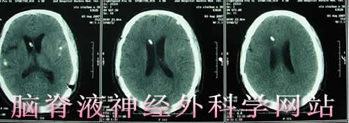 脑脊液神经外科学网站