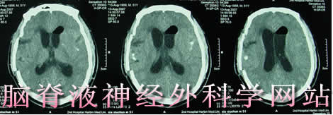 脑脊液神经外科学网站